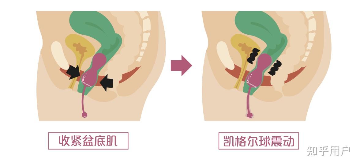 凯格尔球,凯格尔训练法是什么? - 知乎