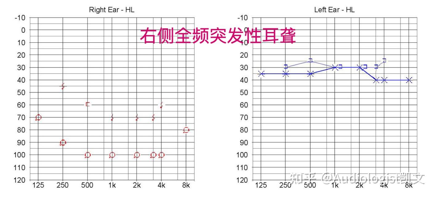 如何看懂听力检查报告！快来看看吧～