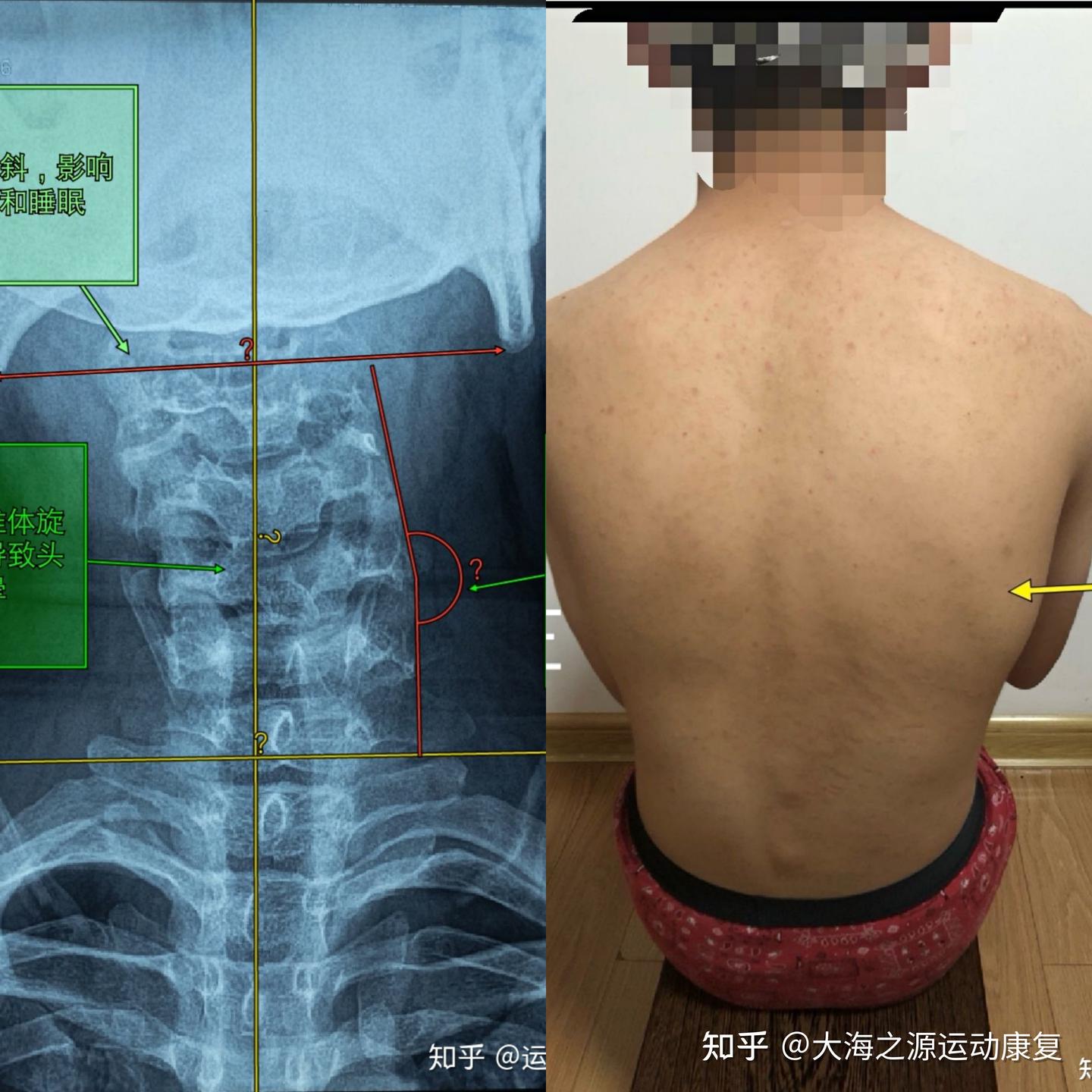寰枢椎半脱位为什么稳定不住? - 知乎