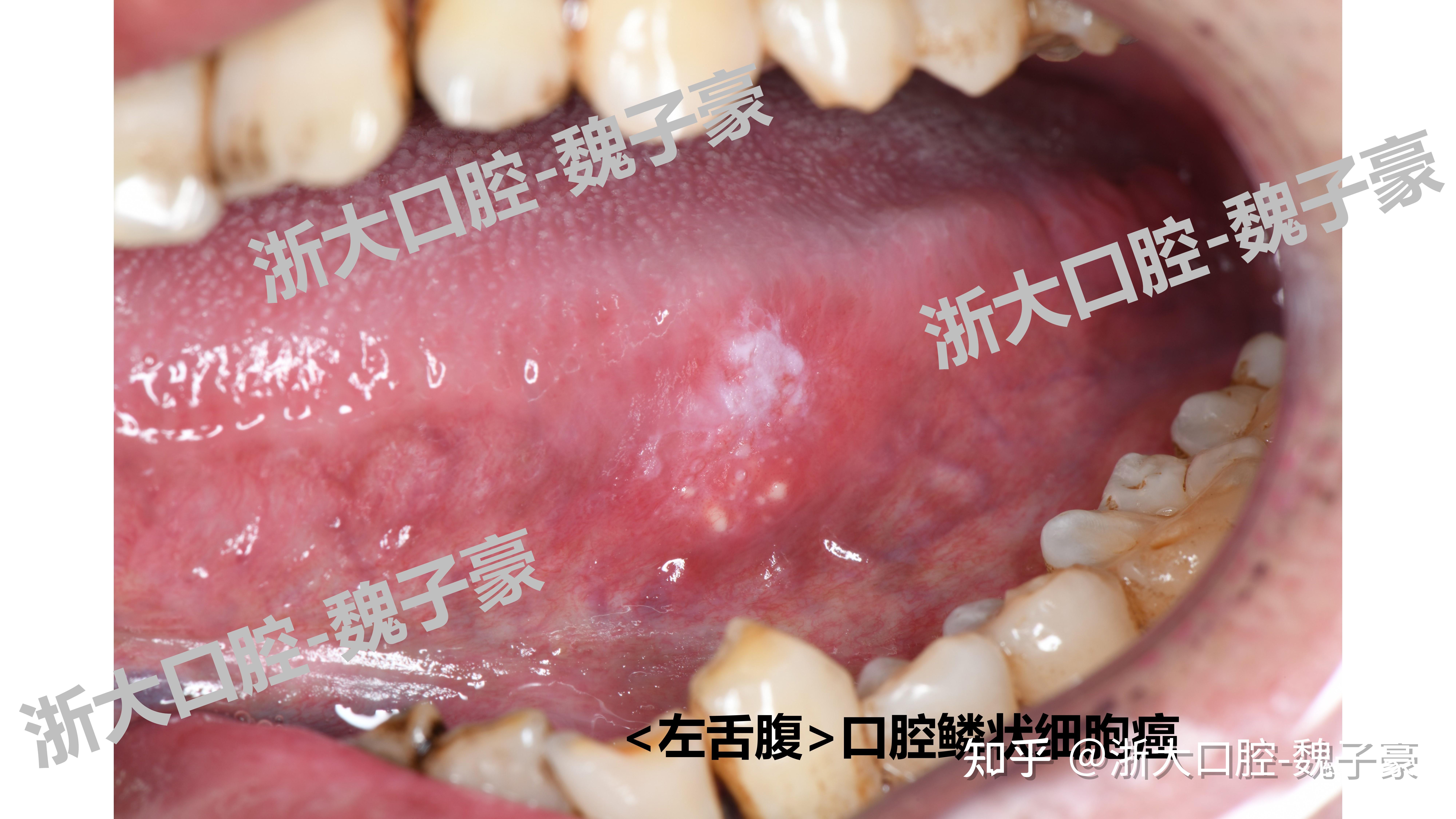 形形色色的口腔癌 - 知乎