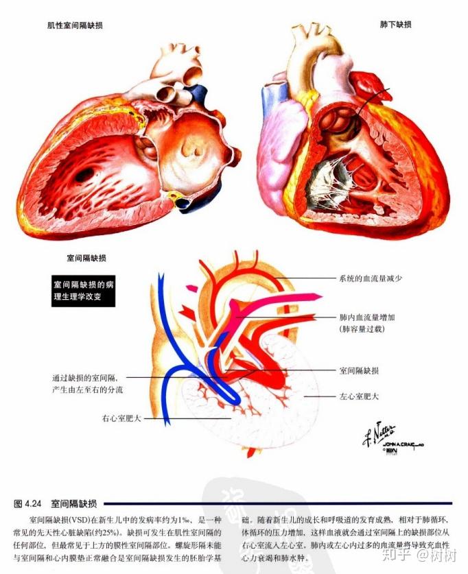 先天性心脏病室间隔缺损术后可以剧烈运动吗?可以上体育课吗? - 知乎