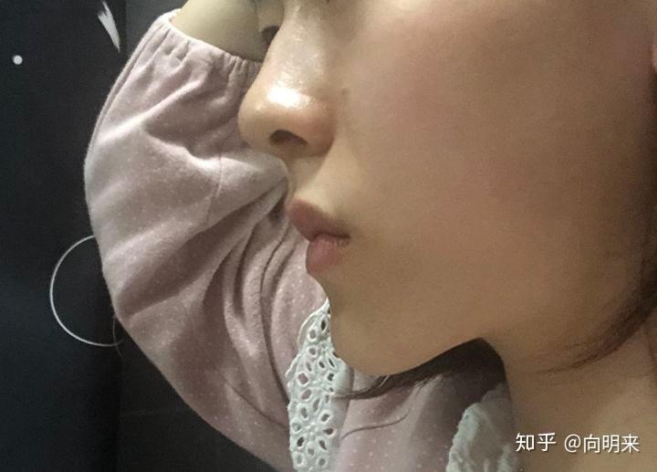请问我这是下巴后缩还是凸嘴呢?怎么改善呢?