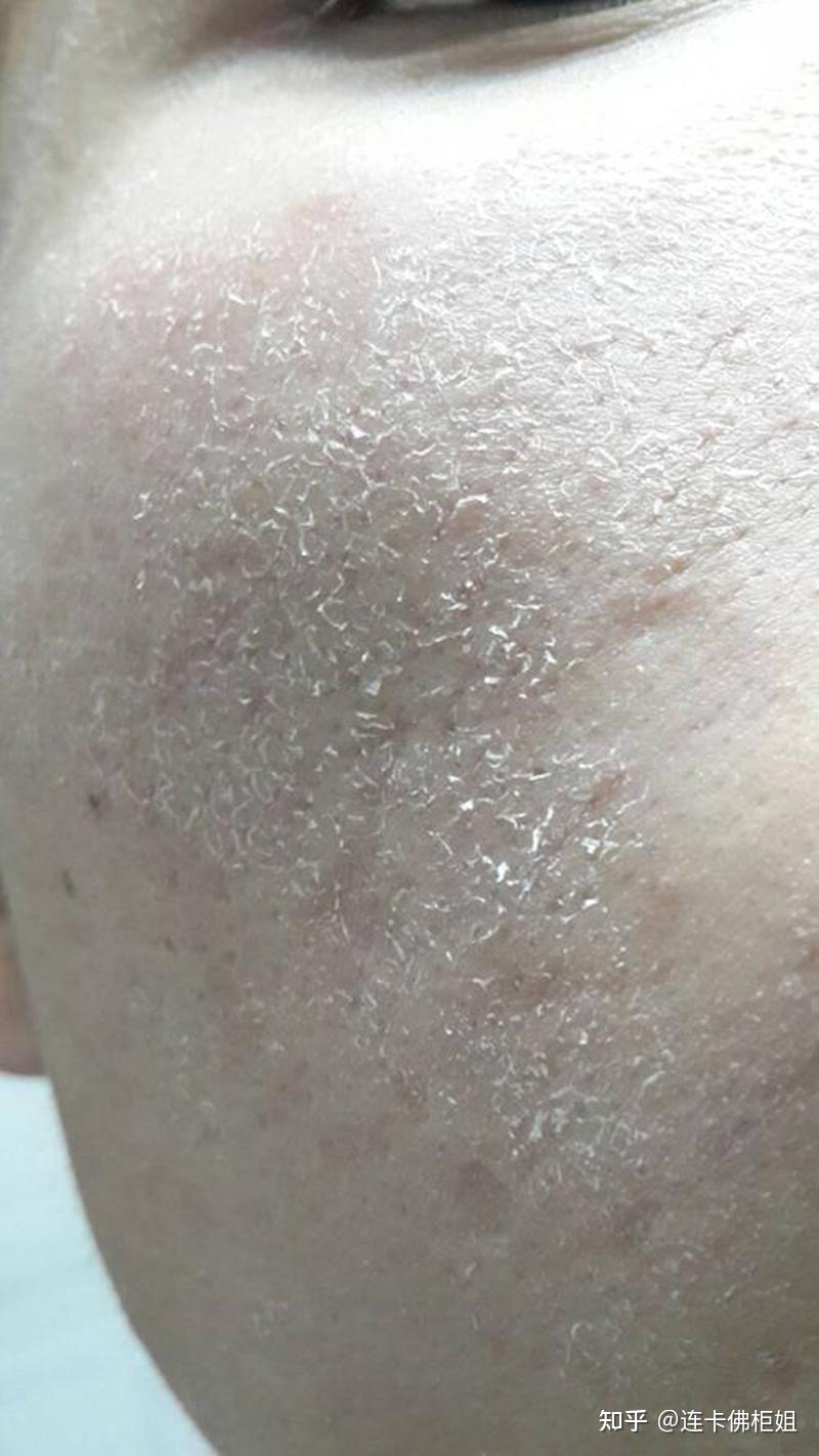 秋冬皮肤干燥,爆炸起皮,还红敏刺痛该怎么办? - 知乎