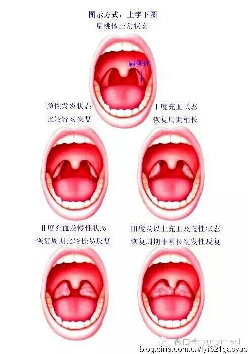 兒童扁桃體與腺樣體手術方式選擇