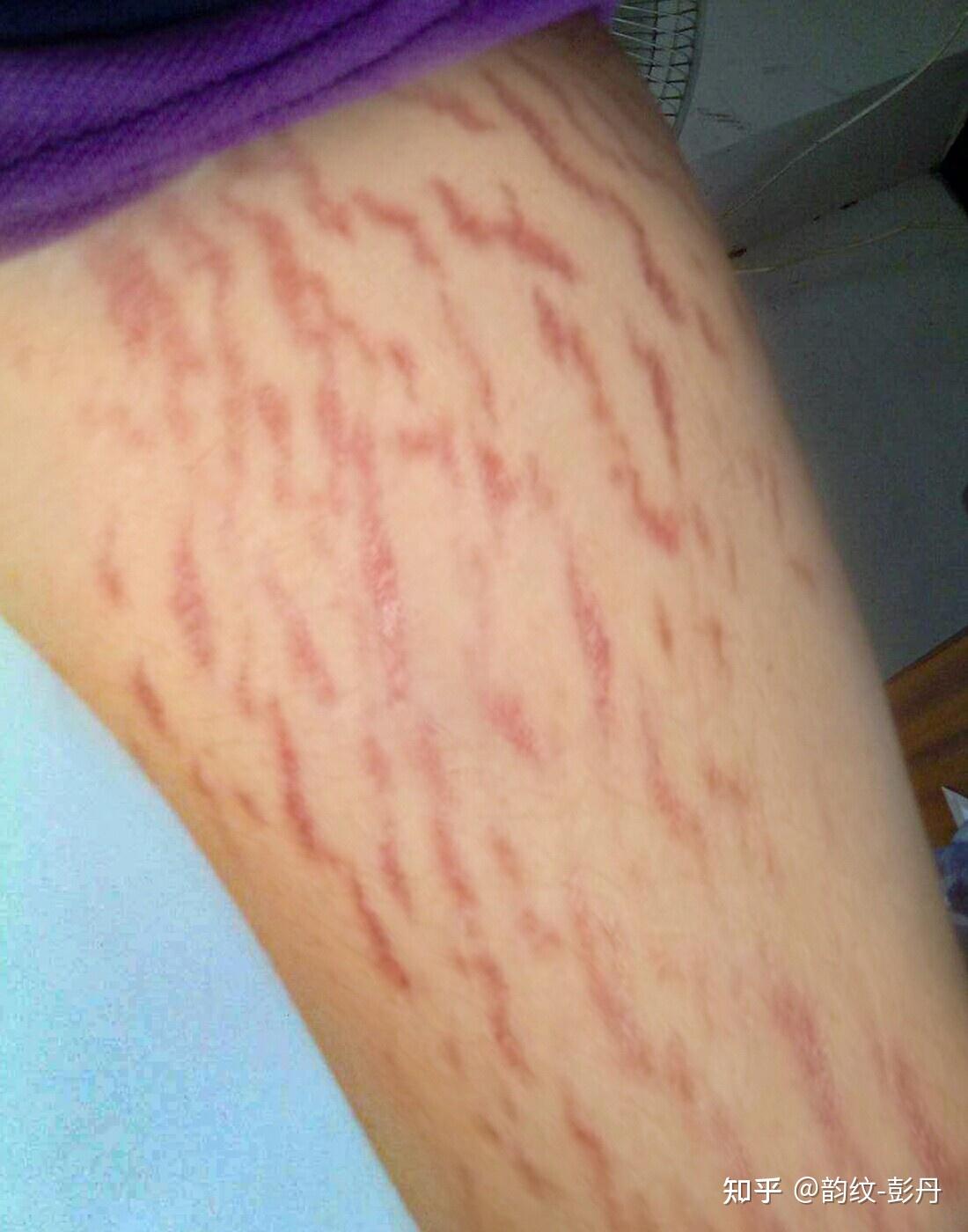 长肥胖纹是怎样一种体验? - 知乎