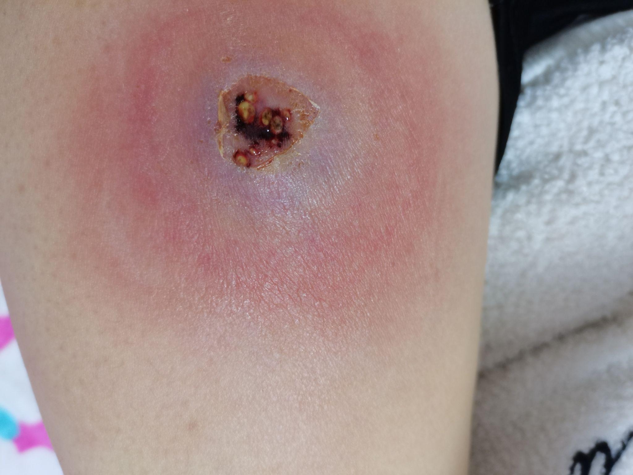 蜂窝组织炎与脓肿的区别?