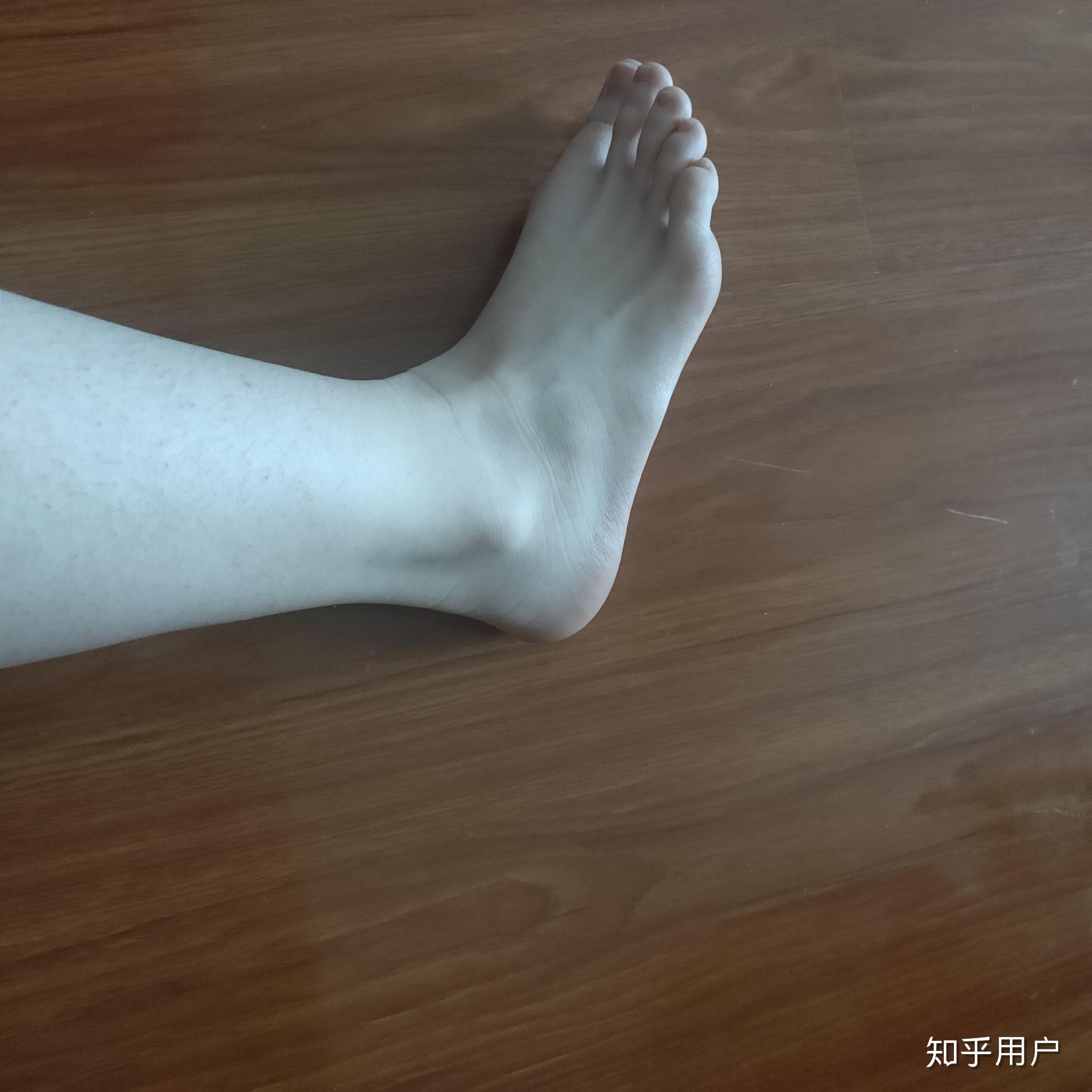 什么样的脚踝叫做没有脚踝