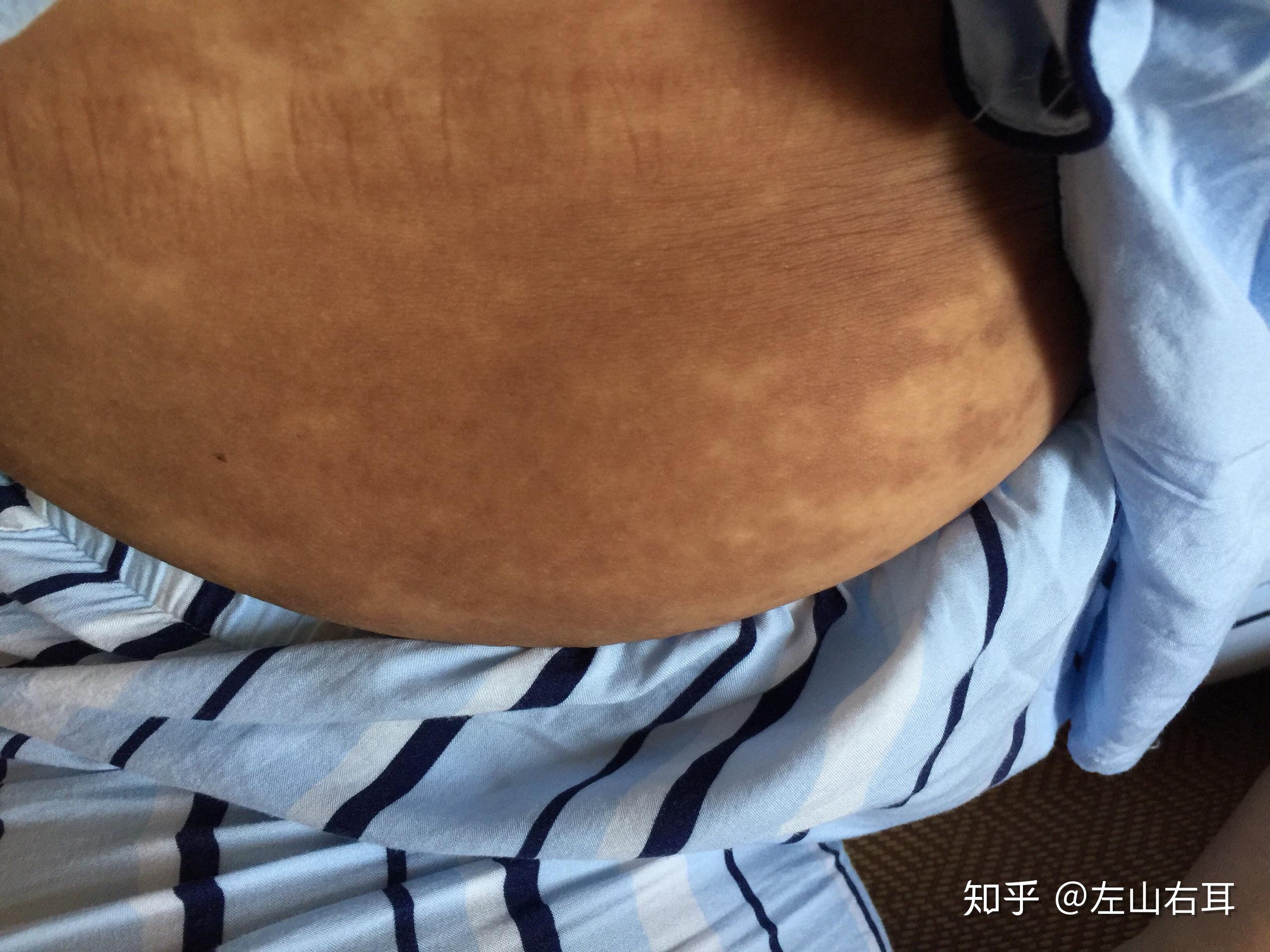 女人生完孩子后肚子的真实状态是怎样的