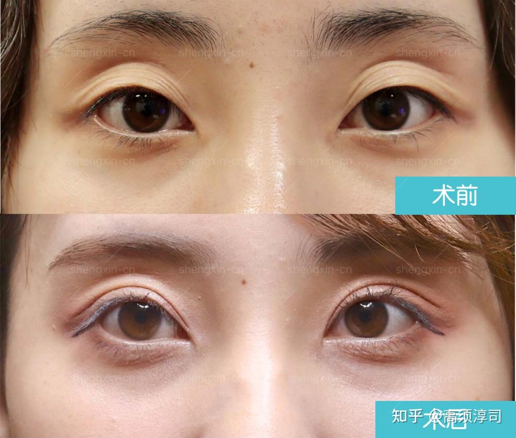 请问做过上睑提肌手术的朋友,大家多久消肿的,比双眼皮慢吗? - 知乎