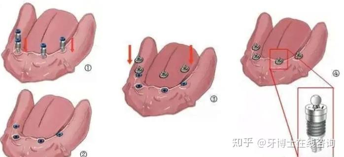 全口種植牙種類目前市場上主流的劃分有:全口種植覆蓋義齒,種植杆卡式