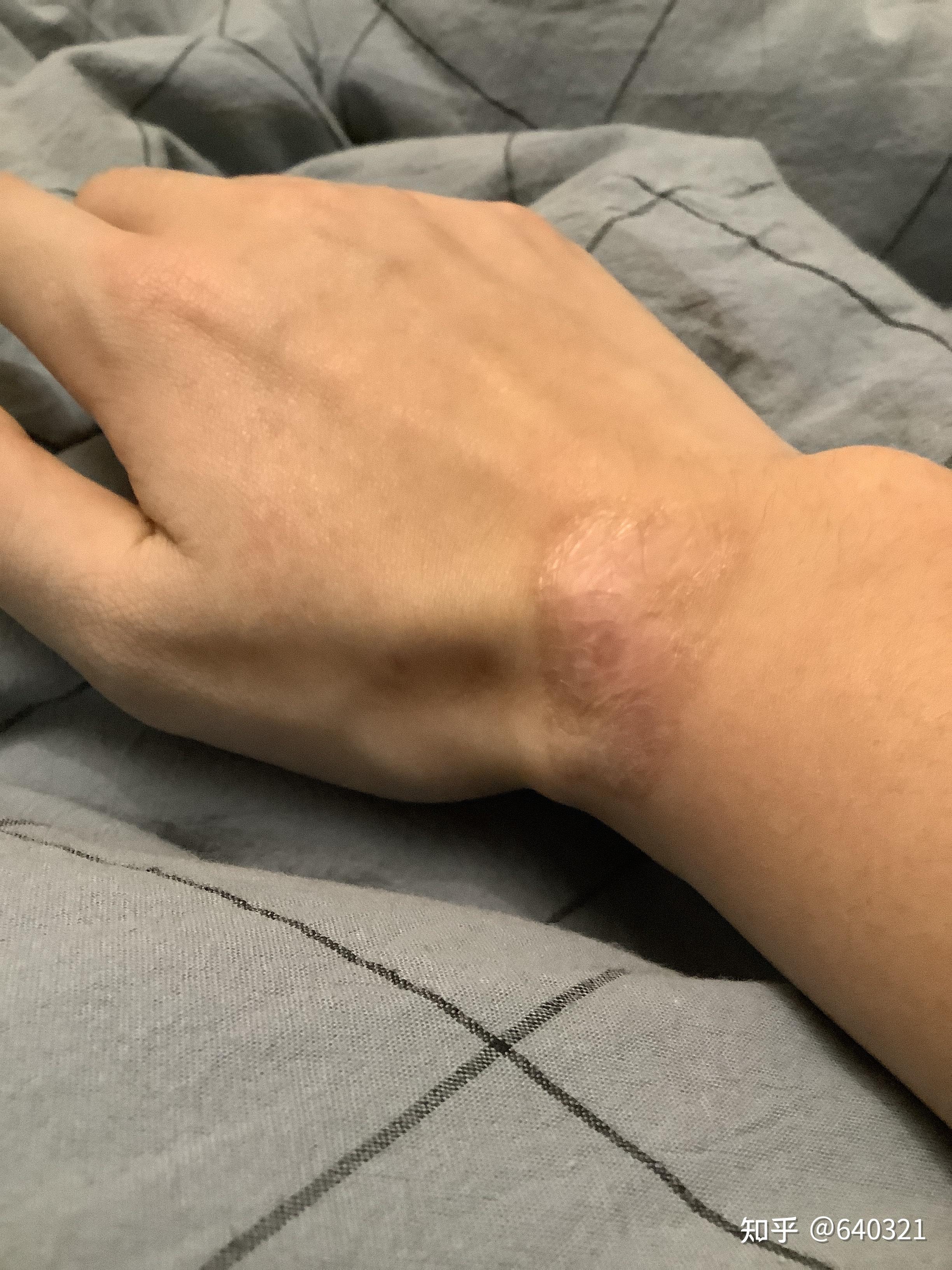 大哥们 手腕上有这种疤痕可以去当兵吗? - 知乎