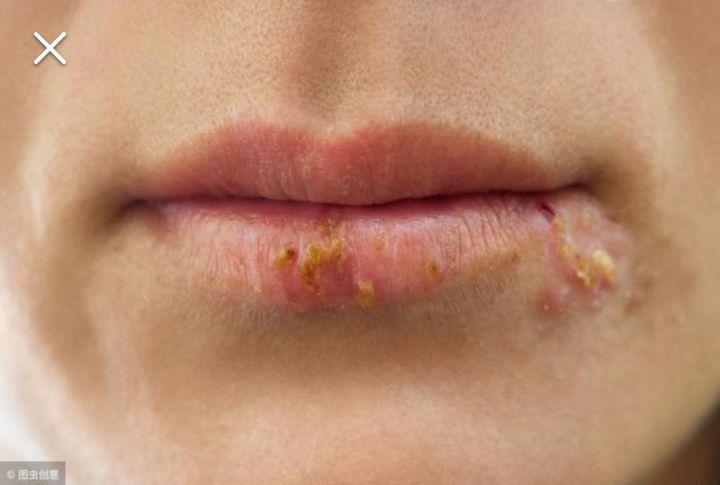 嘴唇疱疹可以用牙膏涂吗