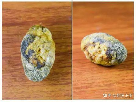 手术取出的混合性胆囊结石