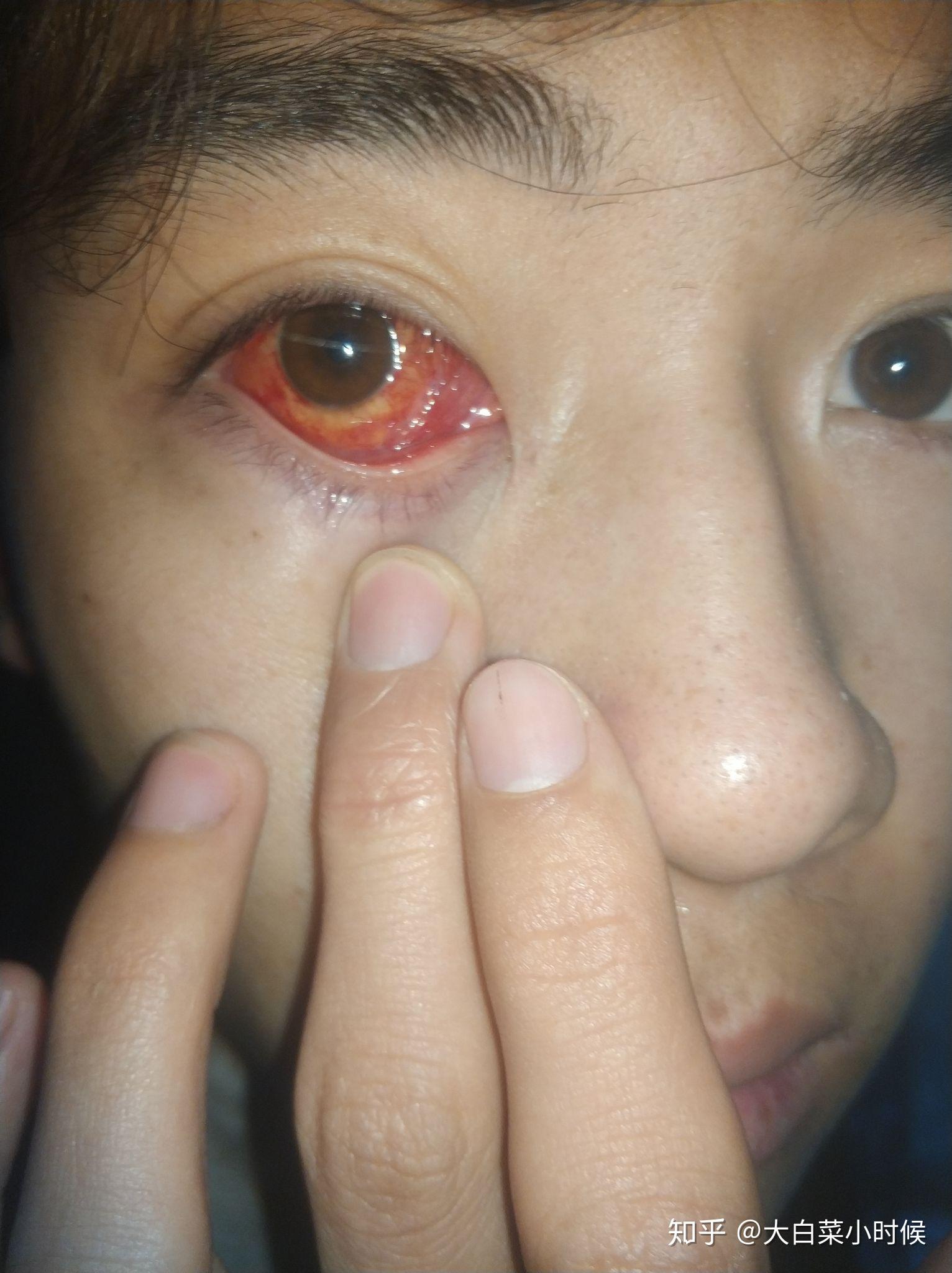 斜视手术是一种怎样的体验? - 知乎