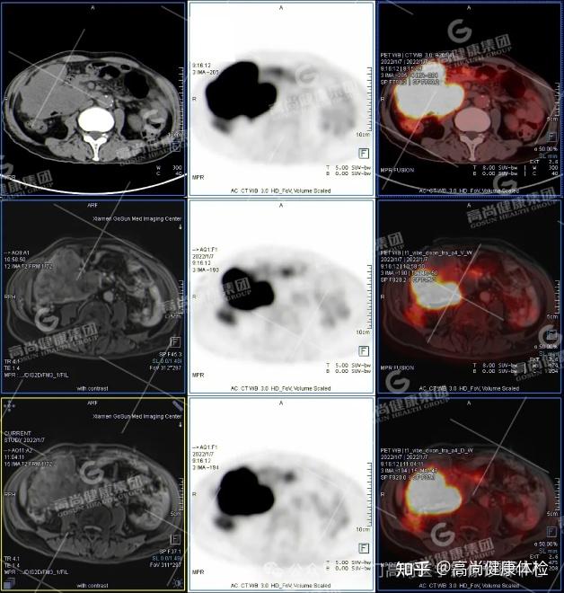 PET/CT-MR 多模态融合技术在临床中的应用病例分享（一） - 知乎