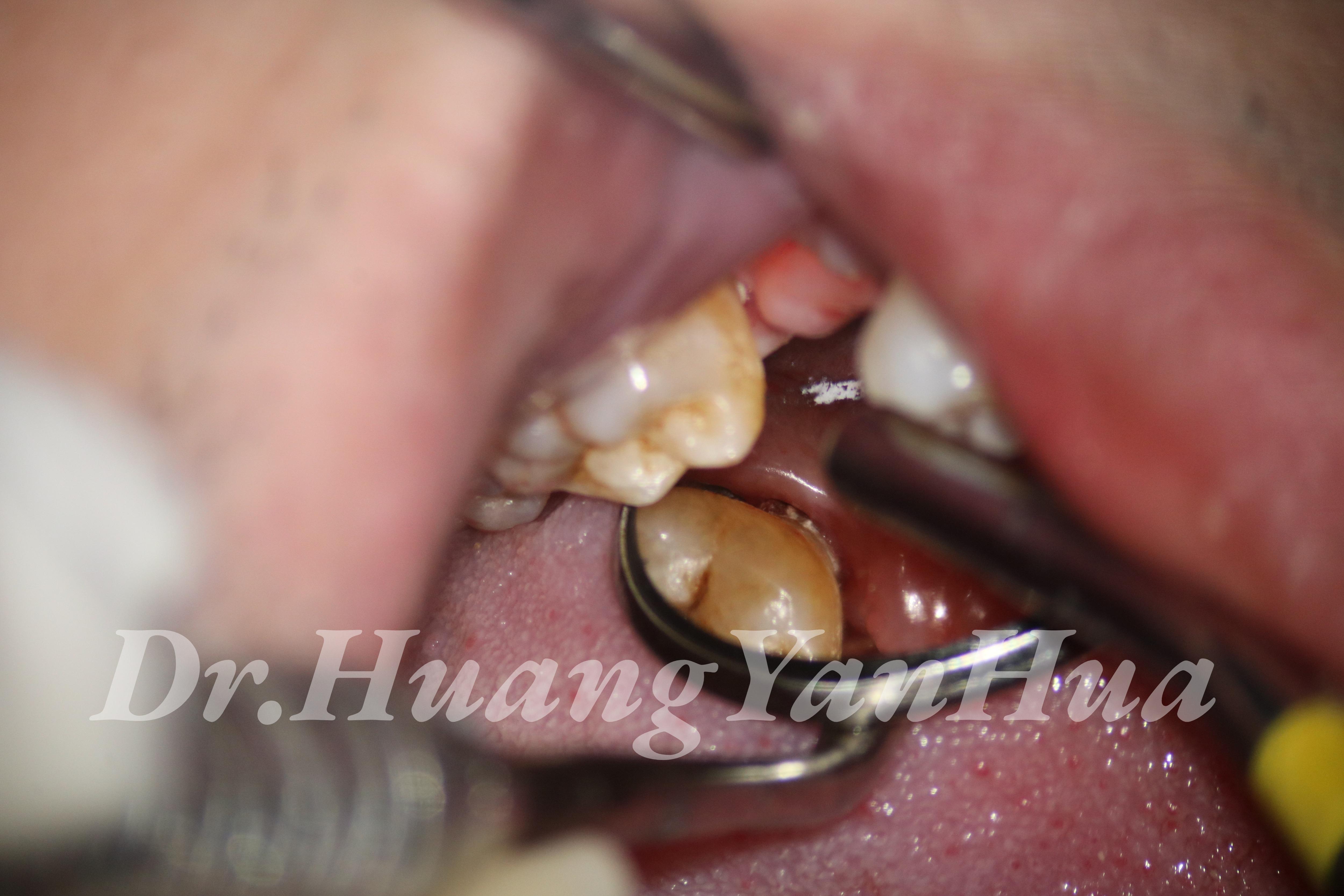 牙周袋深出血——中度牙周炎龈下刮治一例
