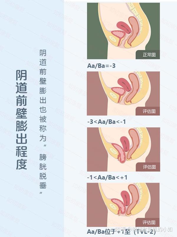 已经盆底阴道前壁膨出膀胱脱垂能做凯格尔运动吗能为什么不能为什么
