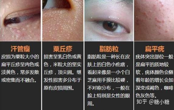 怎样简单有效的去除脂肪粒