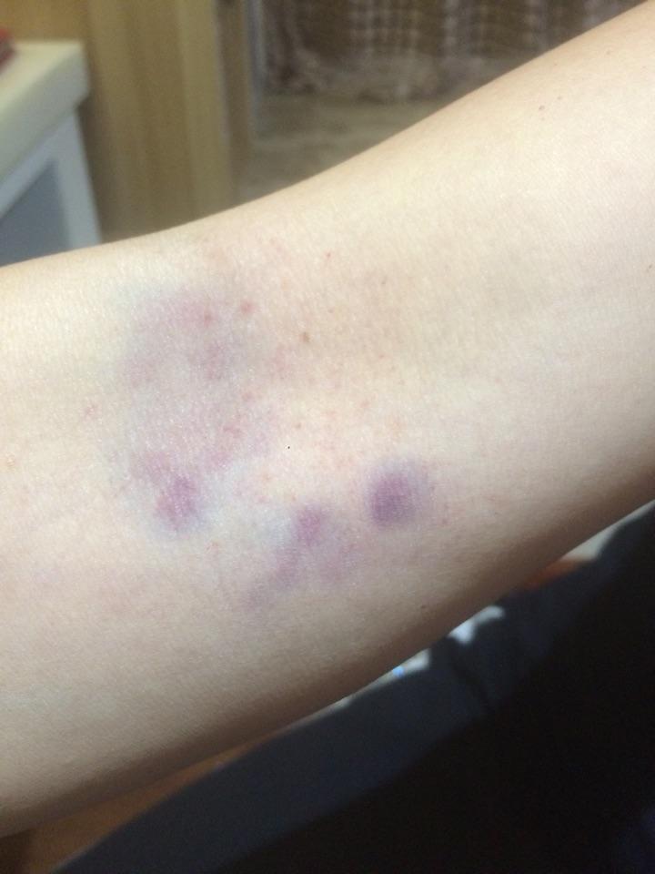 听说拍打胳膊肘弯处可以清血毒结果被拍成了这样子是不是被拍的有损伤