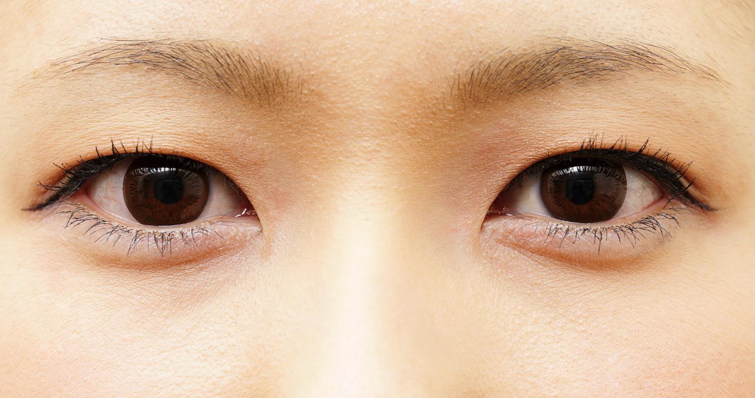 【分享】日本 抽脂埋线双眼皮(超肿单眼皮) - 知乎