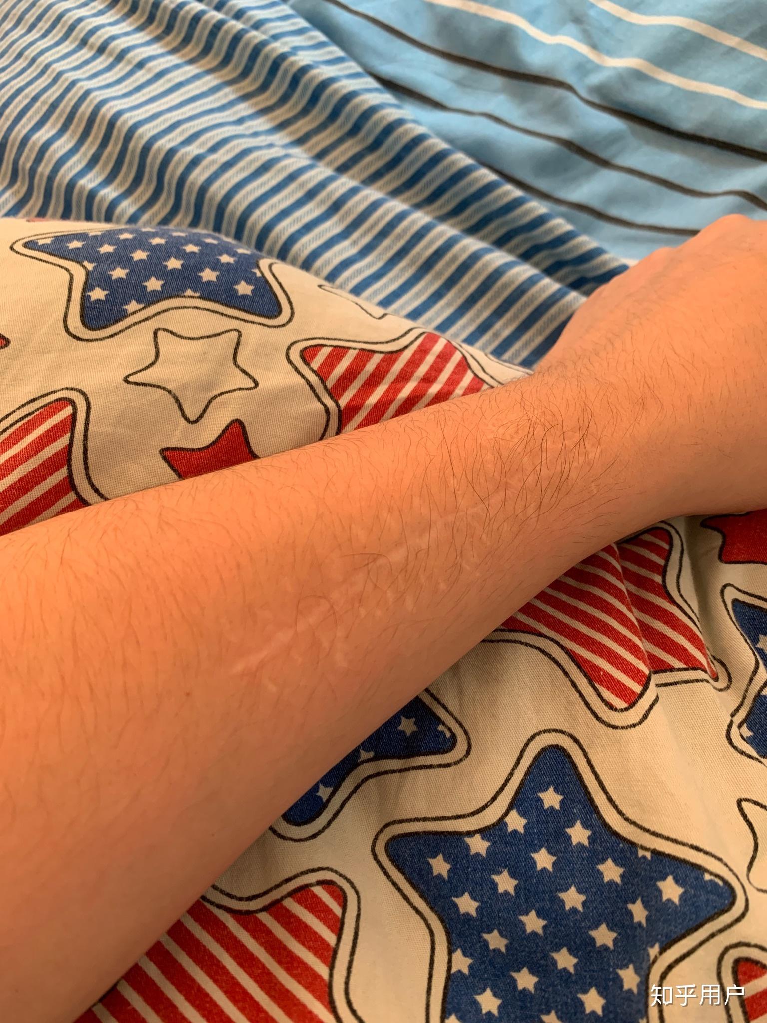 我的右臂有一个手术疤痕,随着慢慢长大,开始变得自卑
