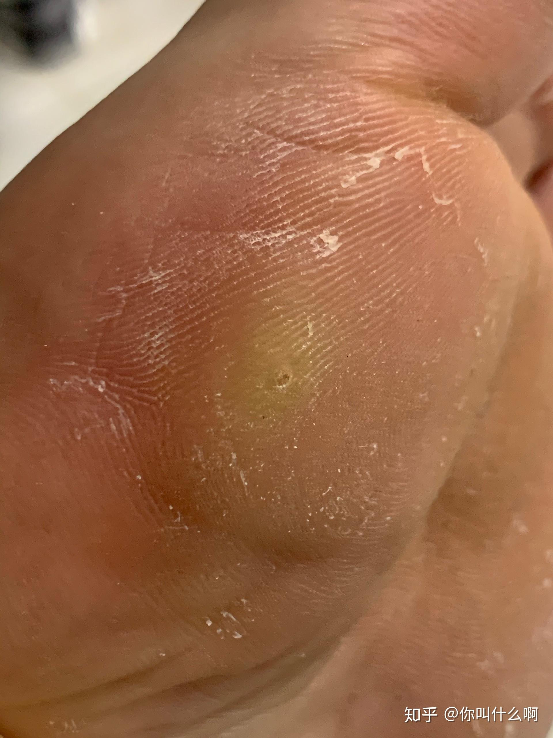 你有脚上长鸡眼的经历吗描述一下感受吧