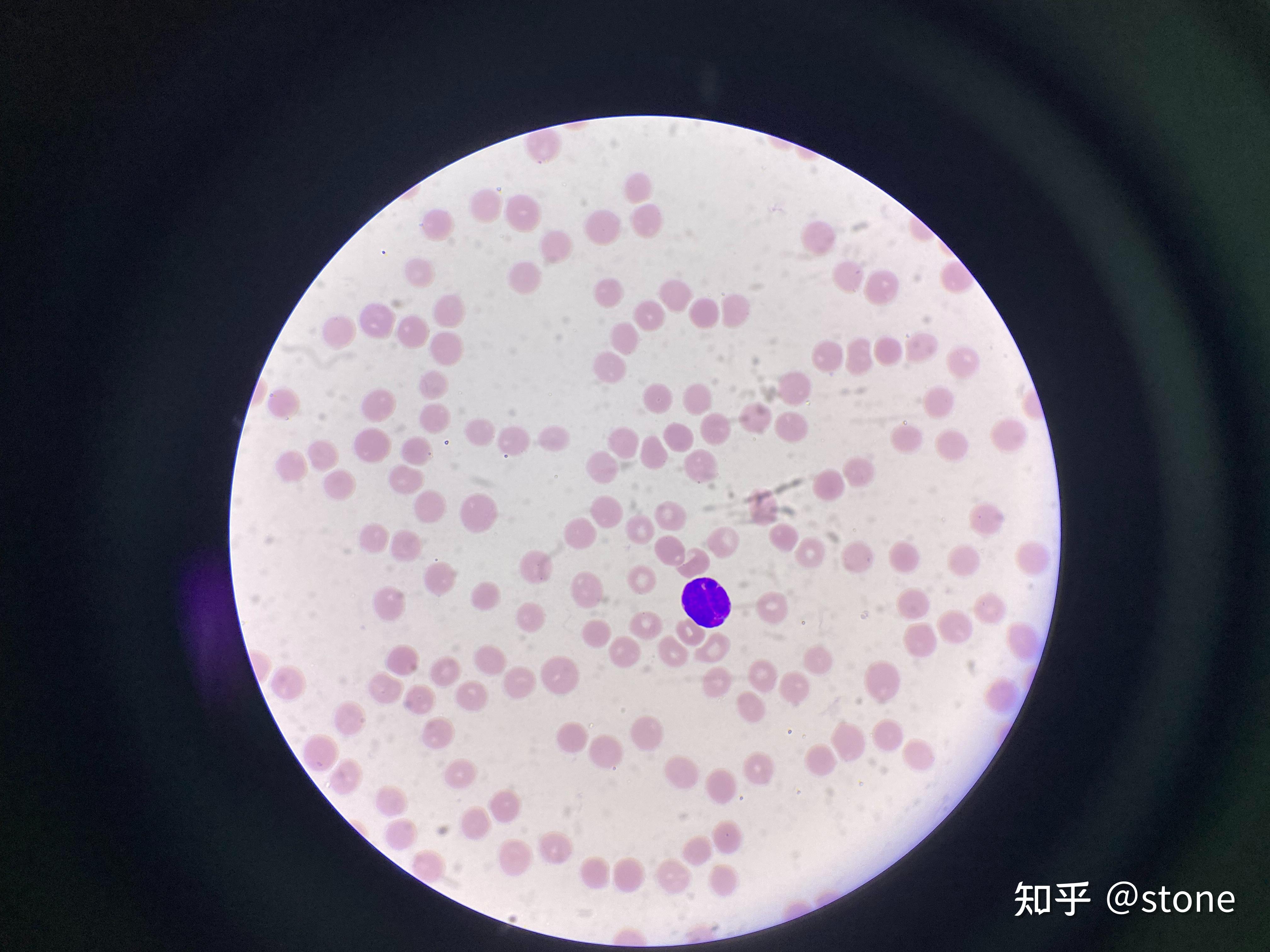 20230807E2021-W28-全血细胞减少-M3 - 知乎