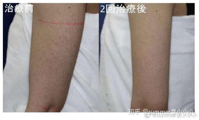脚鸡皮肤改善毛孔医美(腿上去鸡皮肤最有效的方法)