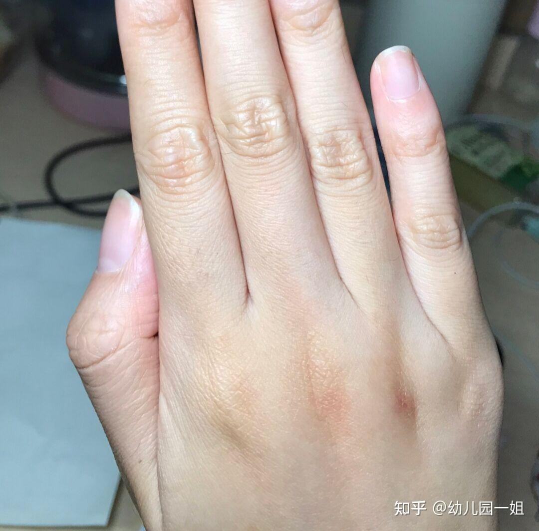 手指关节皱纹怎么处理?