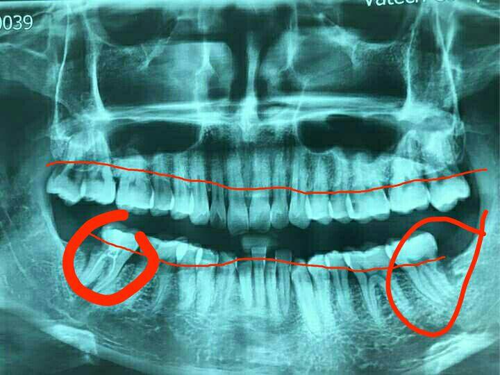 怎样判断牙周炎牙槽骨吸收程度