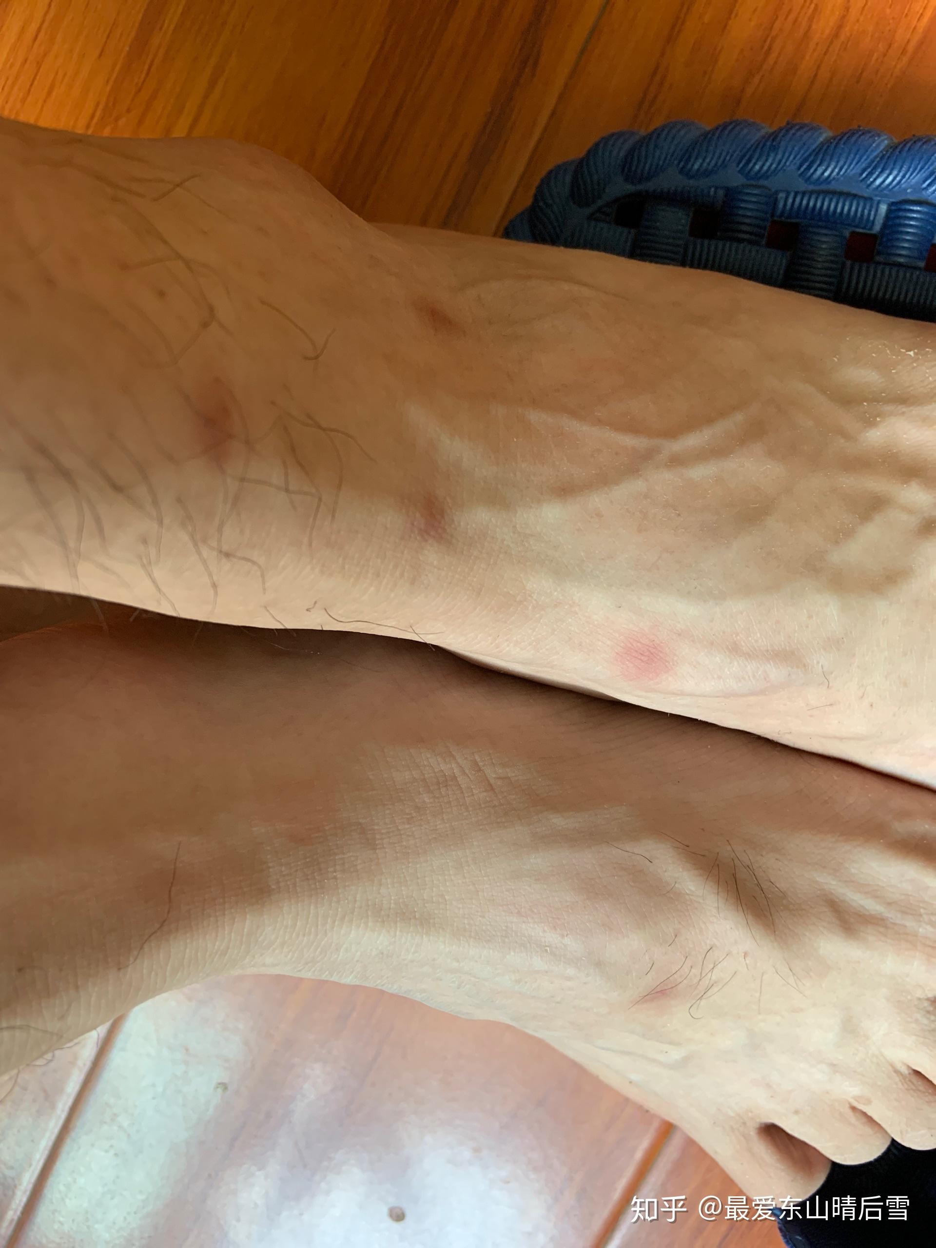 跳蚤咬了怎么办? - 知乎