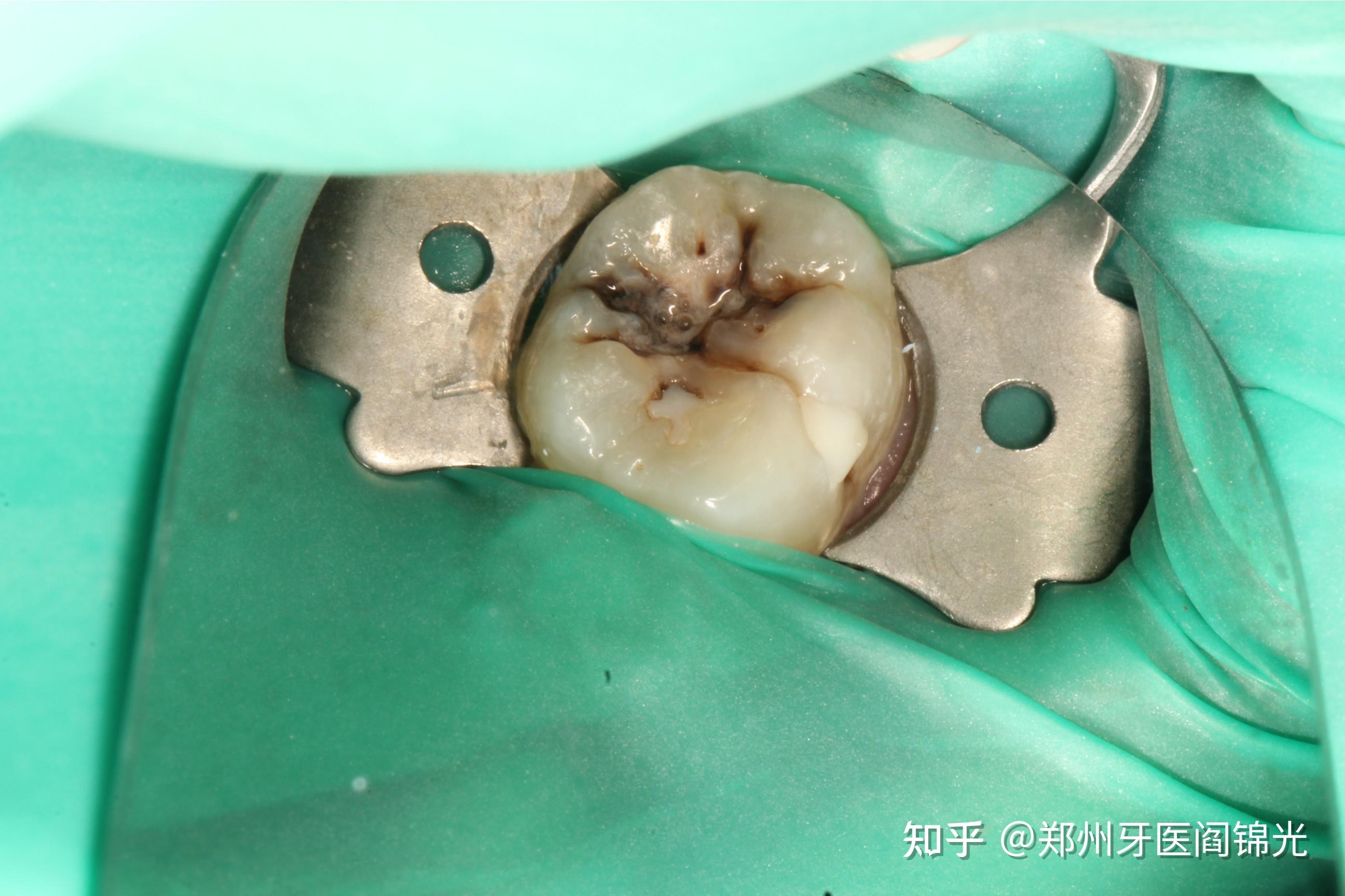 想问一下你们补过的牙坚持了多长时间,补过多少次了? - 知乎