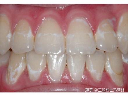 牙齿的矿化和脱矿是什么意思