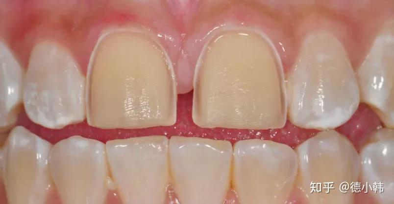 本人去做了超薄牙齿贴面,牙齿表面被磨掉一层,很后悔,得知贴面有许多