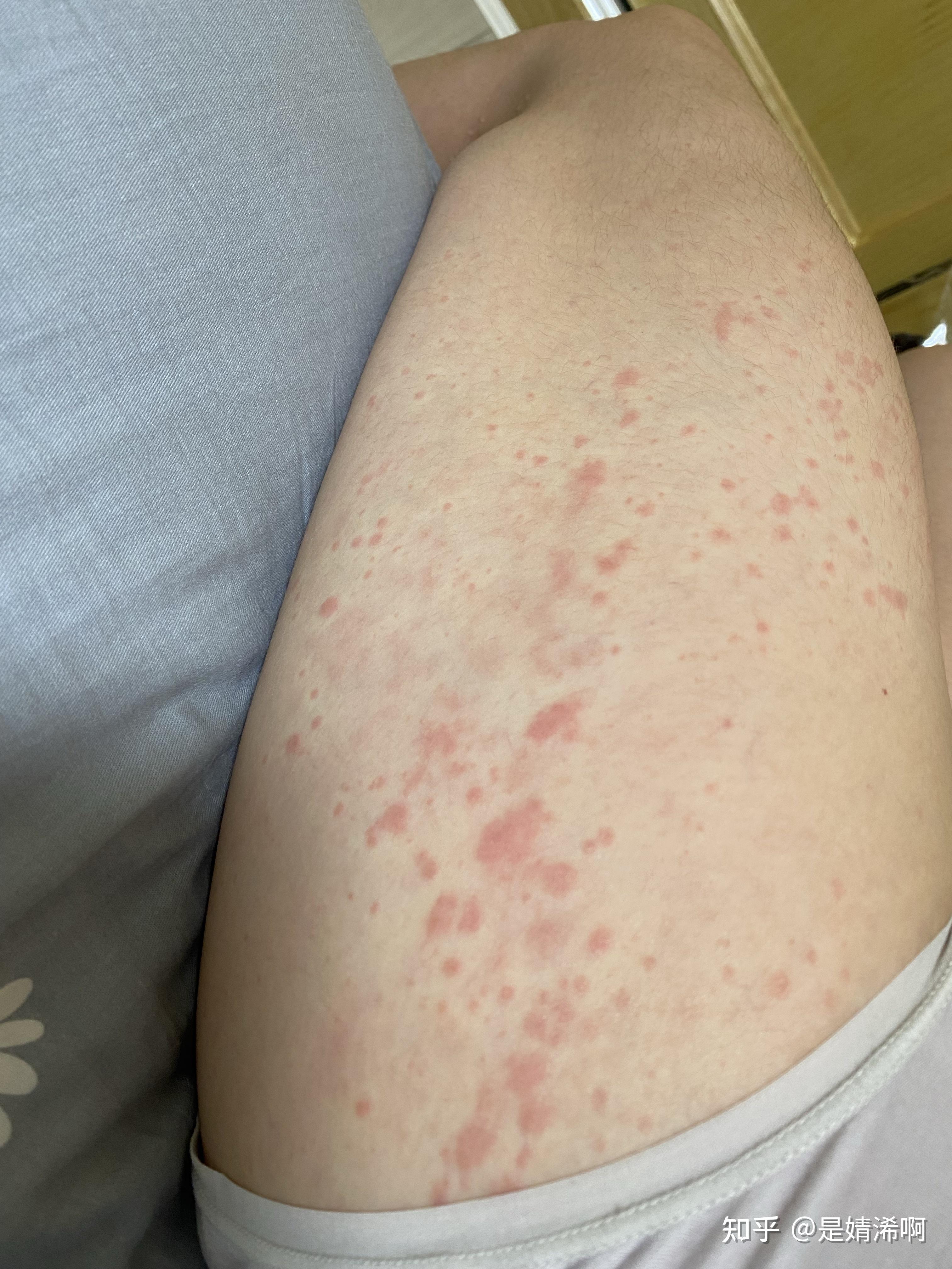 起红斑的地方不痛不痒,其他的不起的地方很痒,有时候背部太痒,会抓到