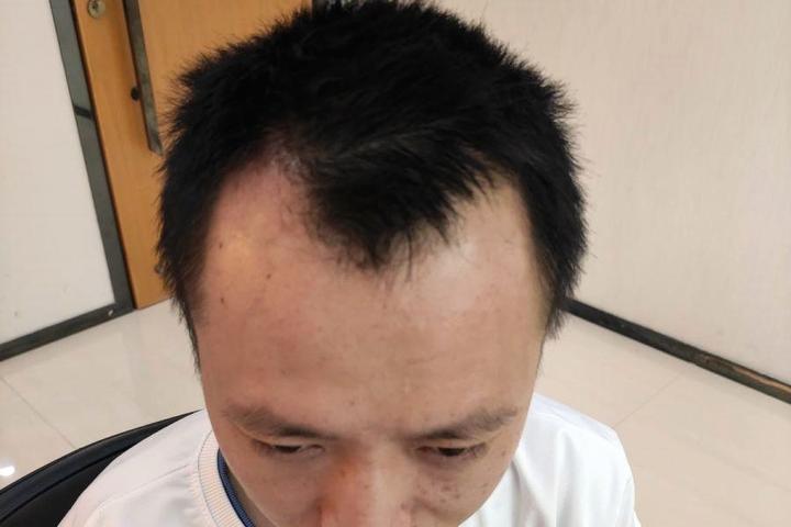 杭州植发前后对比照，真实效果一览 - 知乎