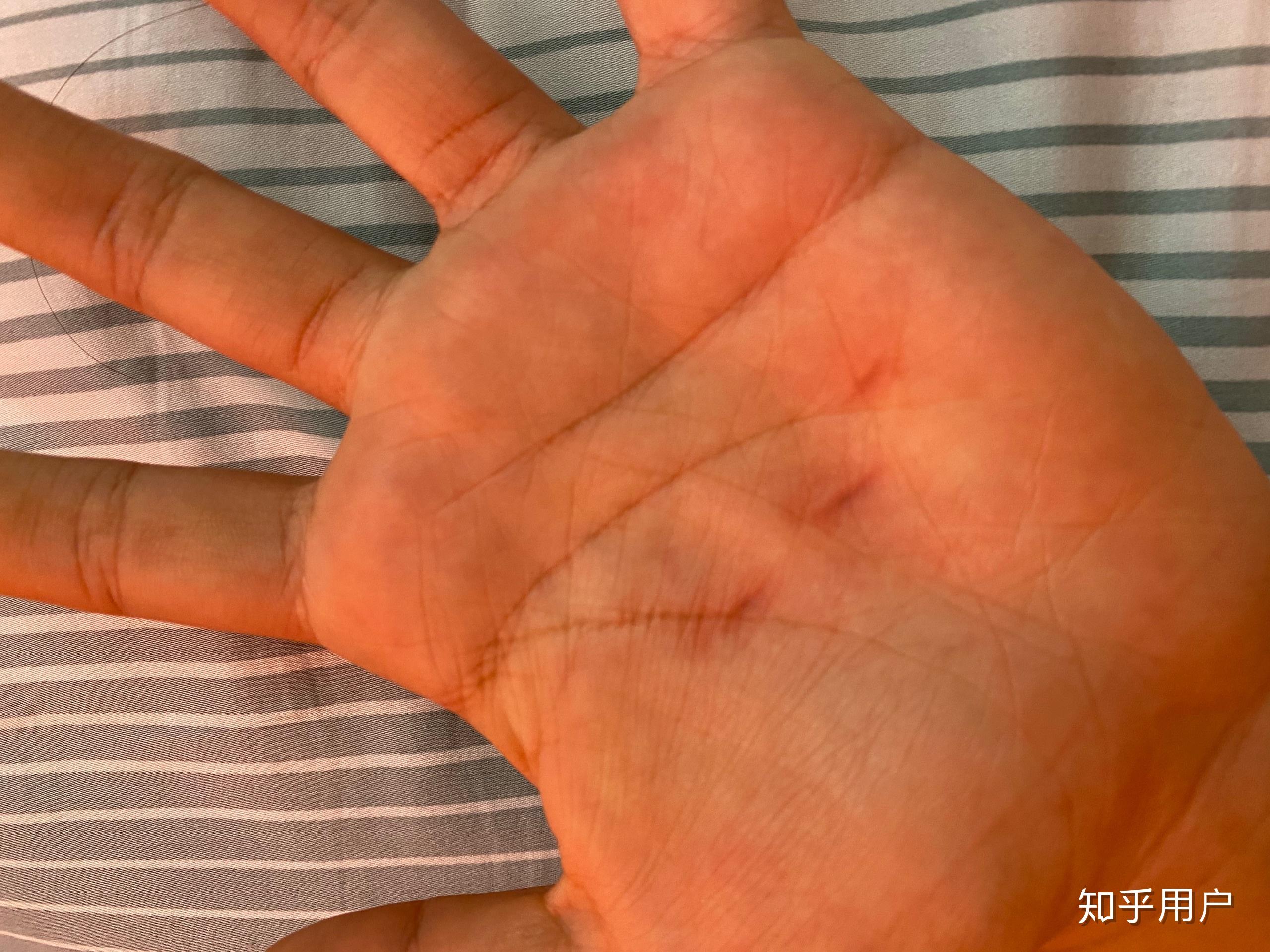 睡觉中经常会紧握住手成拳头状醒后发现指甲掐的手心很深的印是怎么