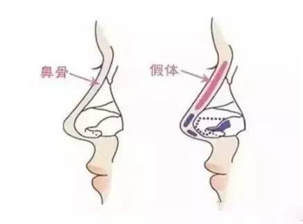 多久可以取出鼻假体 v2-66a29fdda40ead05be0984f698d6c88b_1440w.jpg?source=172ae18b