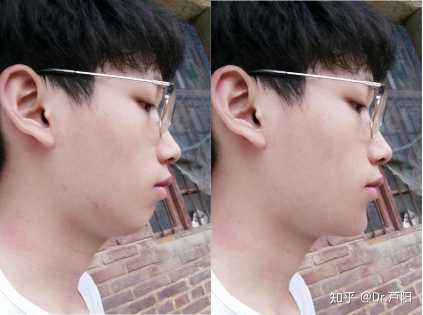 侧颜这样,我是凸嘴还是短下巴? - 知乎