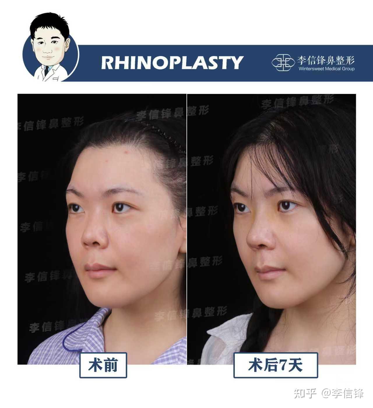 初鼻鼻综合-短鼻朝天、漏鼻孔,鼻基底凹陷改善,术后七天对比~ - 知乎