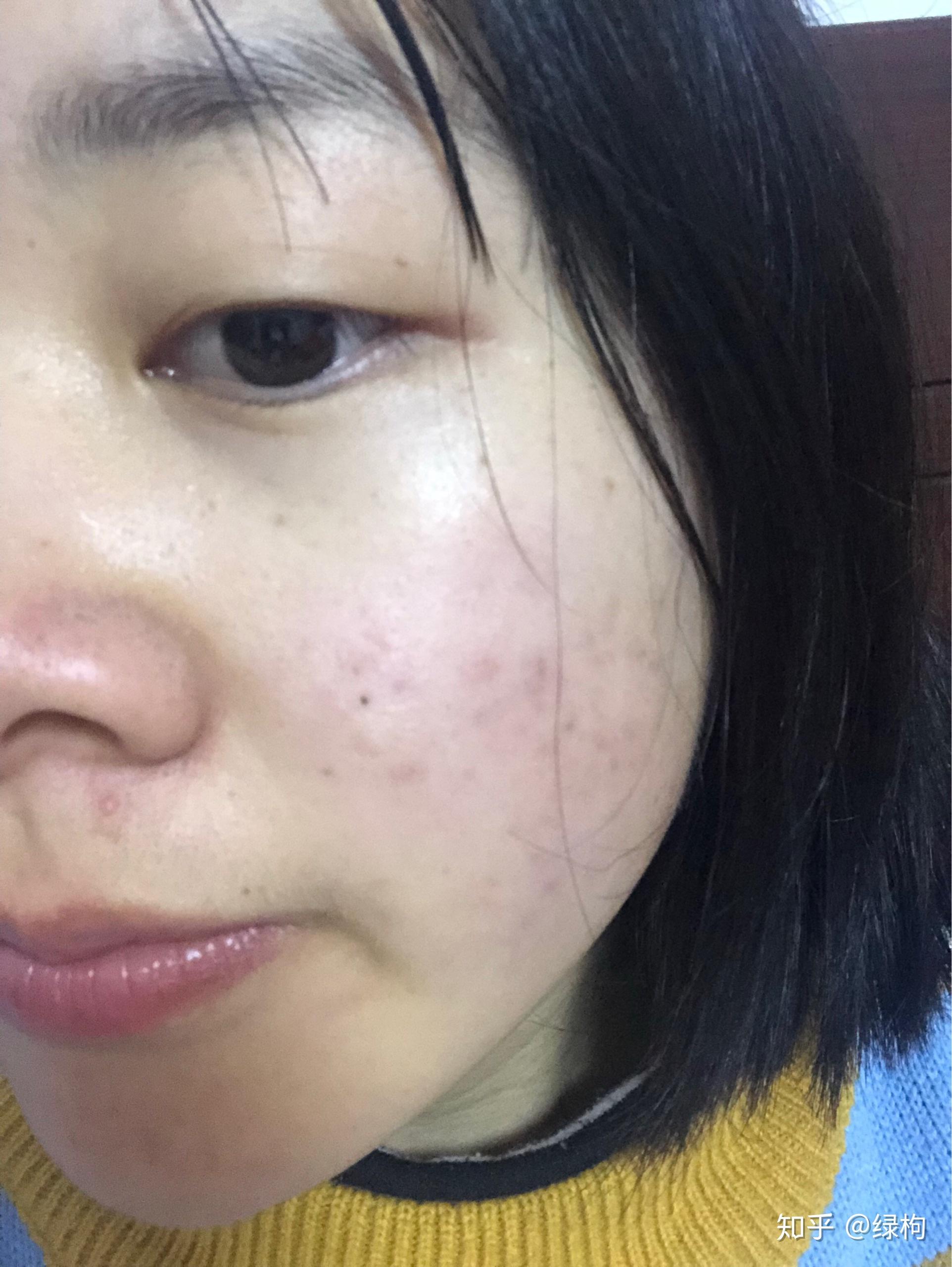 怎么看待五官漂亮但是皮肤差的女性?