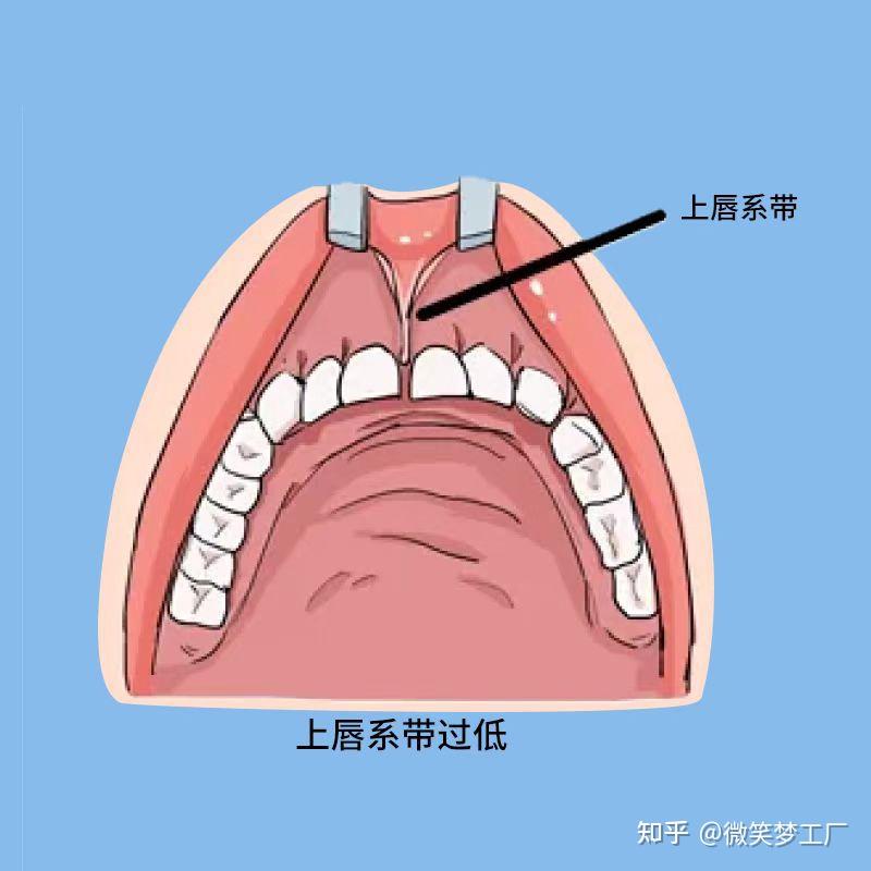 儿童口腔畸形,你真的了解吗? - 知乎