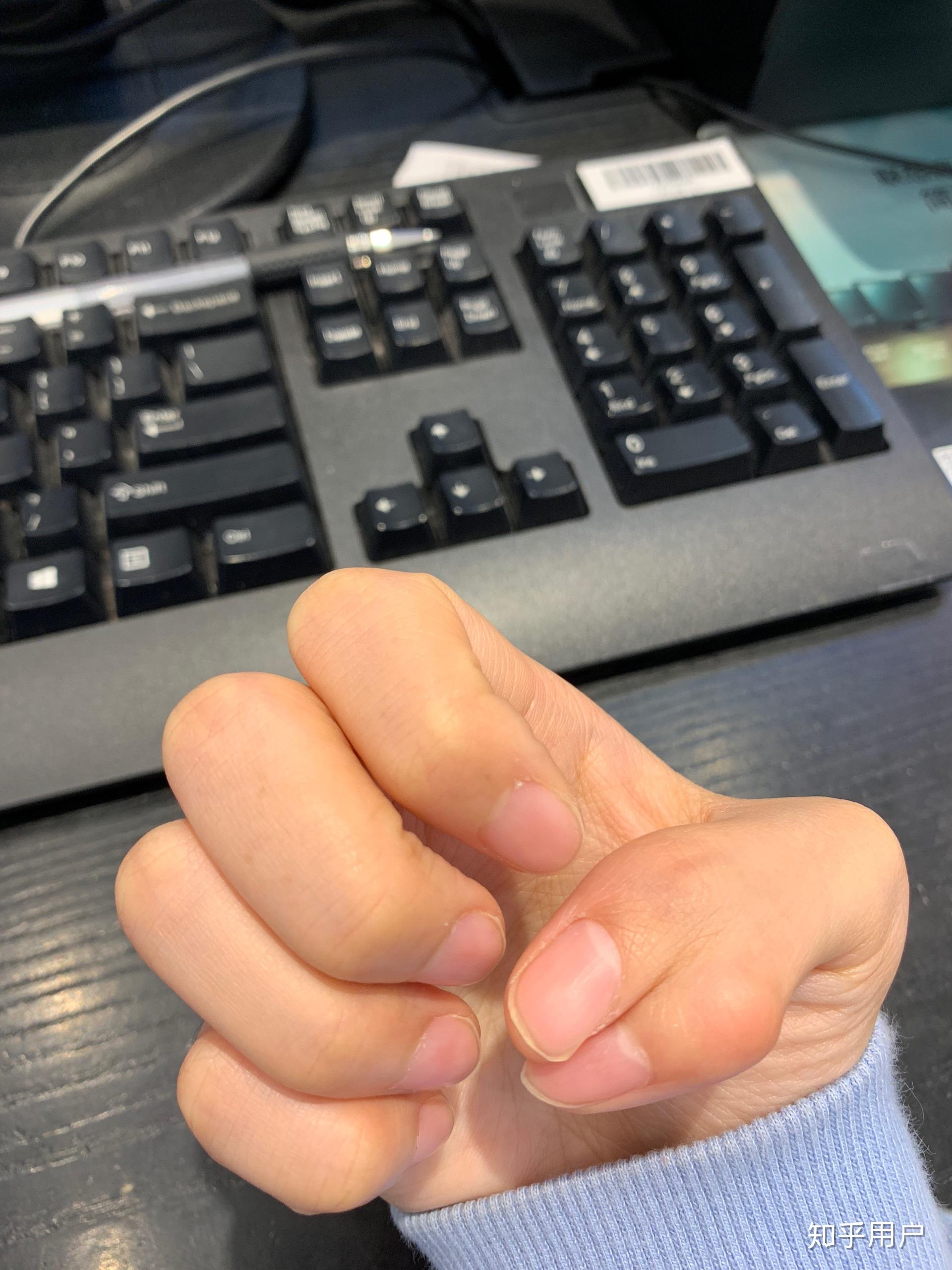 一只手有六个手指是种怎样的体验