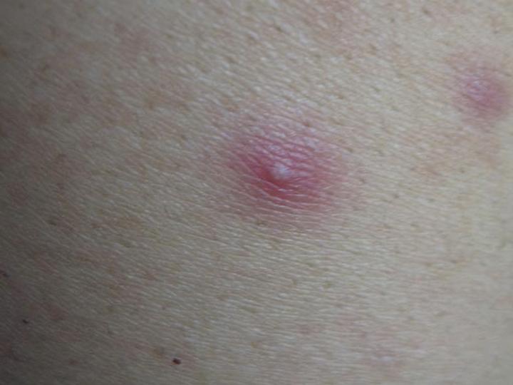 外阴长红色痘痘一碰还很痛别慌可能只是细菌感染