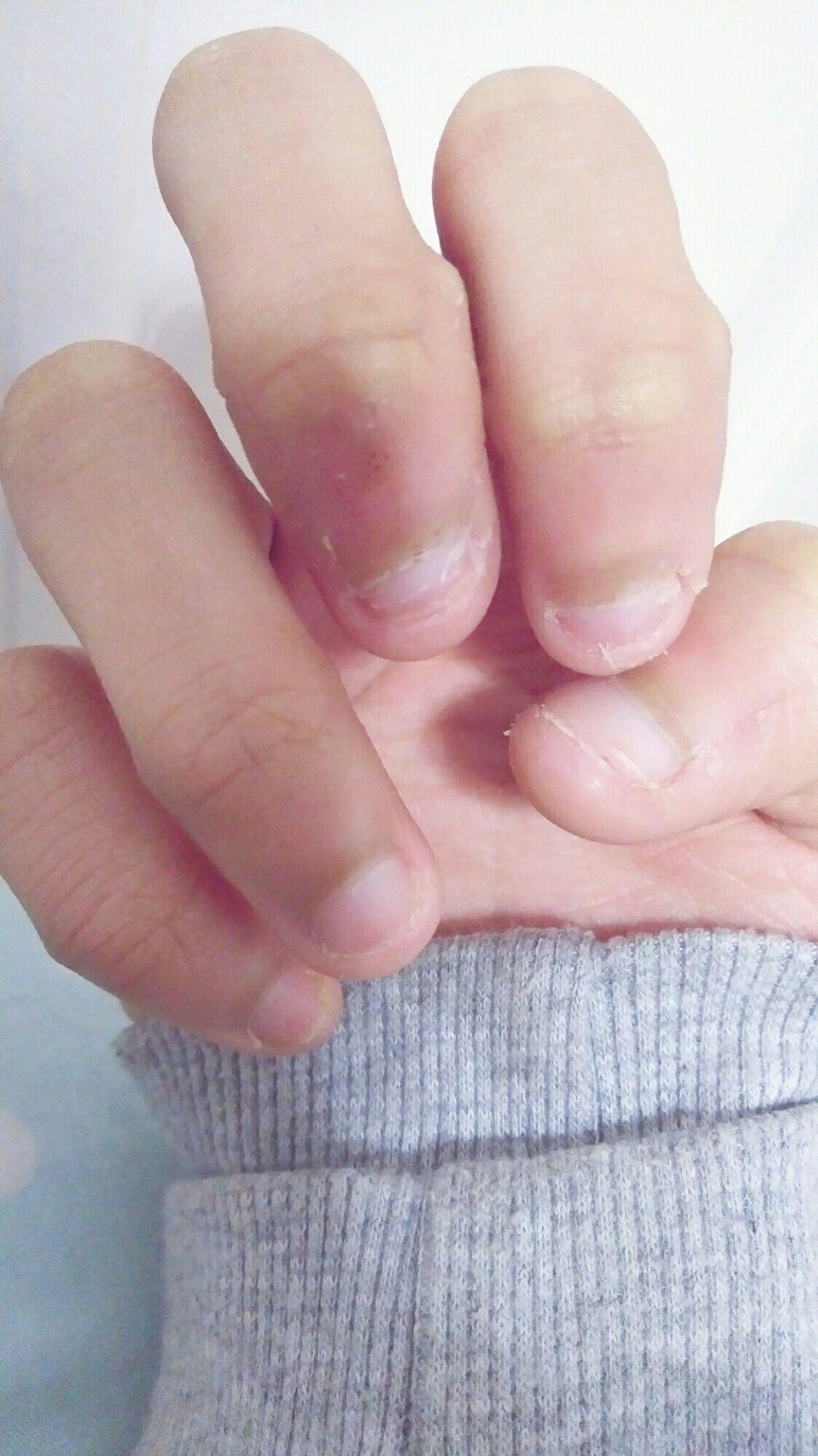 手指甲被咬的超级短怎么办