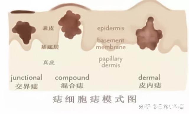 身上有黑痣可怕吗?平平无奇的一颗痣,怎么会癌变了呢? - 知乎