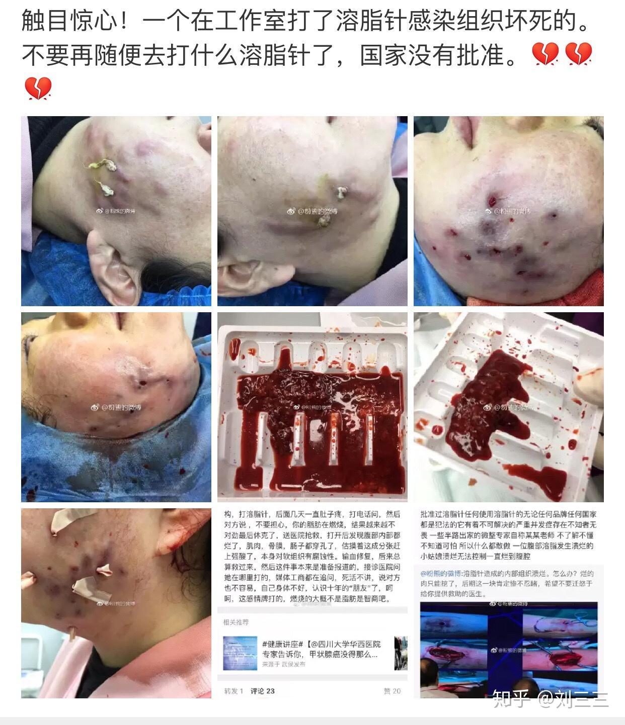 最近很火的6d小脸针是什么