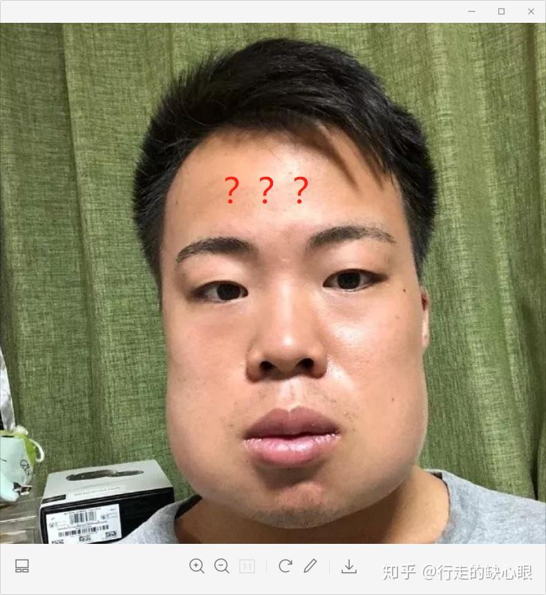 拔完四颗智齿会影响脸型嘛