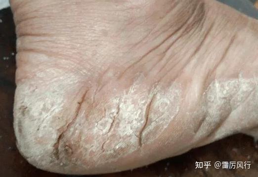 角化型脚气用什么药膏?