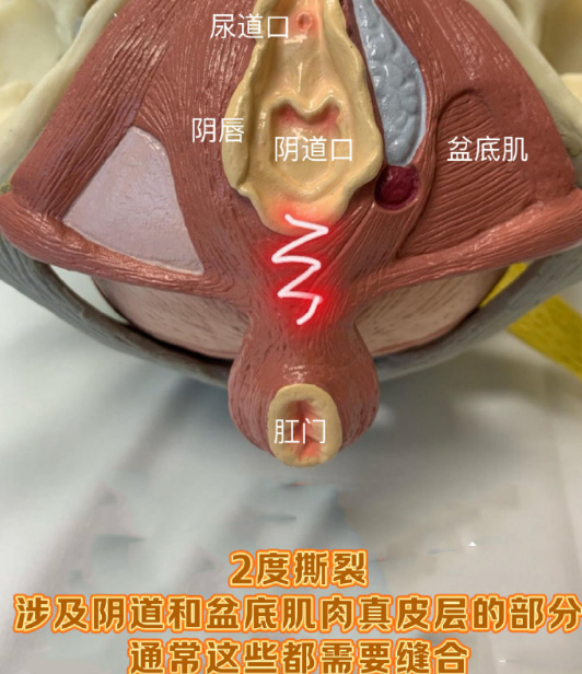 顺产阴道撕裂的四个等级 #十顺九裂